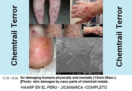 for damaging humans physically and
                          mentally (13min.38sec.). [Photo: skin damages
                          by nano parts of chemtrail metals. Chemtrails
                          are exterminating everything