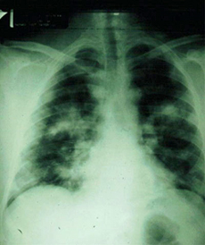 Pneumonic plague, x-ray foto