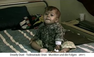 Irak, ein Kind mit NATO-Schaden durch
                            eine Atomrakete, die verniedlichend
                            "Uranmunition" genannt wird 01