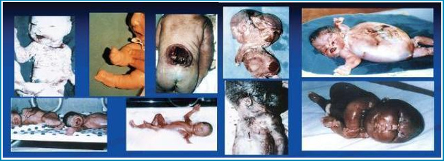 Krebs-Kinder in Basra durch Uranmunition der                kriminellen Zionisten-"USA" 01