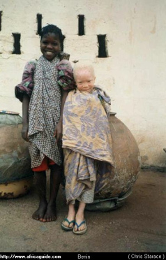 Albino-Bub
                und schwarze Kollegin (www.africaguide.com)