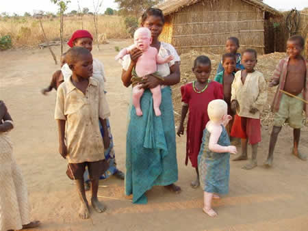 Familie mit 2 Albino-Kindern