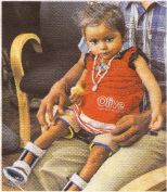 Baby Lakshmi nach der Operation 2007 (03)