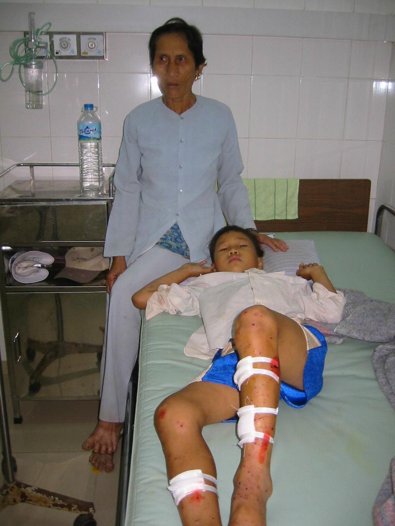 Minenopfer Quang Tri 2, mine victim