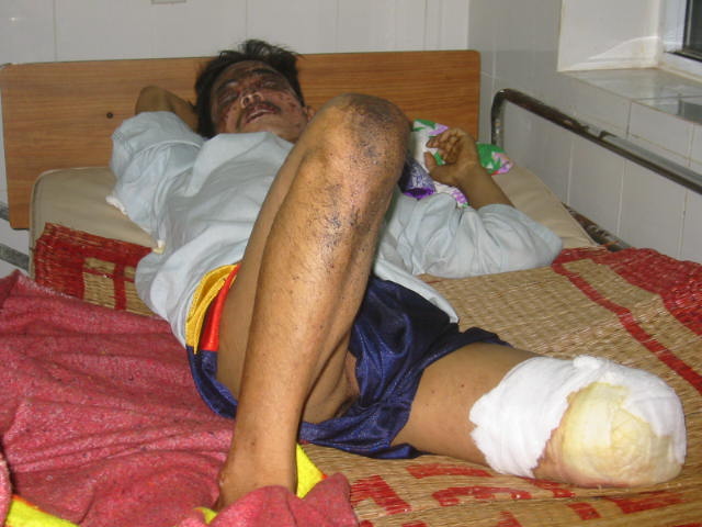 Uxo-Opfer, Quang, uxo victim