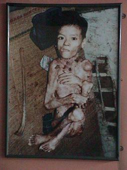 Opfer von Agent Orange im Vietnamkrieg, agent
                orange victim