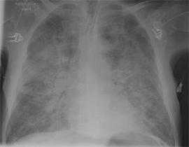 Foto radiogrfica de un edema pulmonar