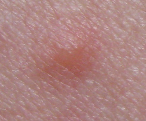 Ein Stich entwickelt eine Blase [16.9.2025 01]