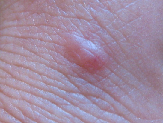 Ein Stich entwickelt eine Blase
                  am linken Zeigefinger 01
