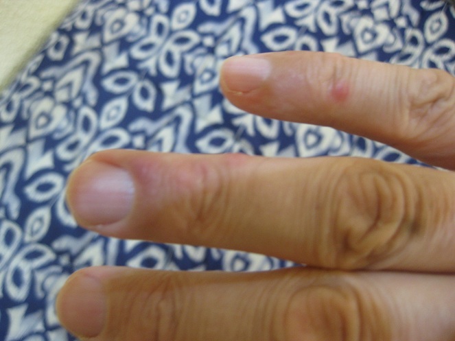 Stiche an der rechten Hand: kleiner
                  Finger und Ringfinger