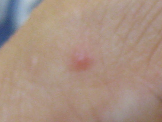 Stiche an der rechten Hand: am Zeigefinger
                  Zoom