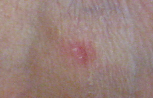 Stiche am linken Fuss Innenseite Zoom