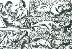 Smallpox epidemic in Tenochtitln