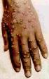A hand
                              infected by smallpox