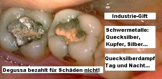 Amalgamfllungen: Degussa bezahlt fr die Schden
                  nicht