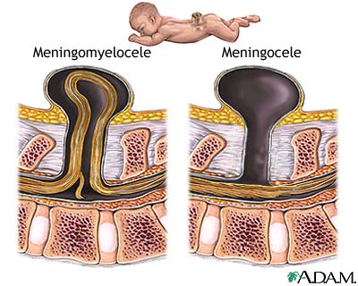 Spina bifida (offener Rcken), Schema
                            des Austritts des Rckenmarks aus dem
                            Rcken, der durch Quecksilberdmpfe whrend
                            der Schwangerschaft begnstigt wird. Die
                            Medizin will diesen Zusammenhang bis heute
                            nicht akzeptieren...