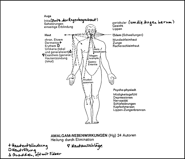 Gasser 1968: Amalgam-Krankheitsschema