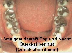 Amalgam dampft Tag und Nacht
                  hochgiftige Quecksilberdmpfe aus