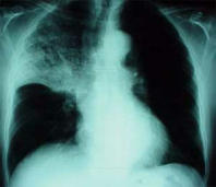 Pneumonia, x-ray photo