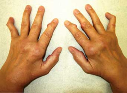 Rheumatoide
              Arthritis (hier mit angeschwollenen Fingergrundgelenken,
              mit Rheumaknoten an Fingergelenken und mit deformierten
              kleinen Fingern) ist je nach Blutgruppe verschieden