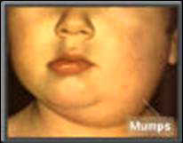 Mumps ist bei
                        Blutgruppe B besonders hufig