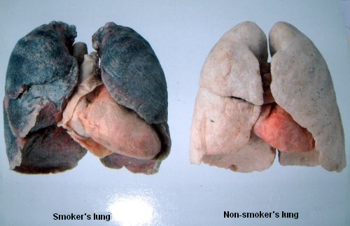 Smoker's lung in black - non-smoker's lung in
              white