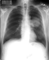 Röntgenfoto zeigt
                          Lungenkrebs