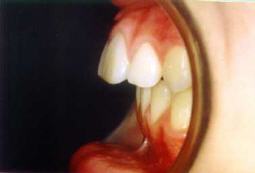 Protrusión o sobre
                        mordida horizontal o dientes superiores salidos:
                        La mandíbula no es bien formada, el maxilar
                        superior es mucho más grande que la mandíbula
                        [32]