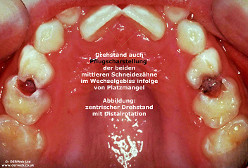 Cuando los dos
                        dientes incisivos frontales no tienen bastante
                        despacio, así salen muchas veces en una
                        "posición girada céntrica", la
                        posición llamada "posición de reja".
                        Además se ve en la foto muchas manchas blancas,
                        precursores de caries, y grandes caries entre
                        los dos premolares [13].