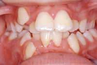 Apinamiento de los
                        dientes, una vista frontal: Un apinamiento de
                        los dientes va ser cuando el bebe solo recibe su
                        alimentación por el biberón y así fue siempre
                        fácil a chupar. Así eso no provoca un grande
                        crecimiento del maxilar. Más tarde los dientes
                        no tienen bastante espacio [2] y la dentadura
                        parece a cereales [8].