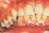Bei der Nonokklusion steht
                              eine gesamte Zahnreihe
                              "daneben"