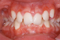 Malformación dentaria Mordida cerrada
                          anterior (sobre mordida vertical profunda)