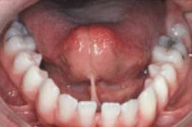 Bändchen (hier ein zu kurzes
                            Zungenbändchen), die zu nah an den Zähnen
                            ansetzen, können an Zahninnenseiten einen
                            Zahnfleischrückgang provozieren