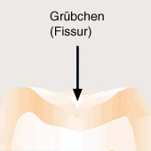 Jeder Backenzahn (Molar und Prämolar) hat
                          jeweils ein Grübchen (Fissur), die so genannte
                          Zahnfurche (hier ein Schema im Querschnitt)