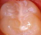 Un
                            primer diente molar con surcos sellados
                            ("fisuras" selladas), con sellado
                            de surcos / sellado de fisuras