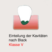 Cavidad de caries según Black, clase 5:
                          Caries al diente incisivo en la región la más
                          profunda [muy peligroso para la raíz del
                          diente]