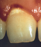 Mancha blanca en un
                        diente incisivo primero (01)