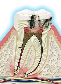 Caries de la raíz
                        del diente (imagen) con nervio inflamado y
                        formación de gases debajo de la raíz del diente
                        [41]