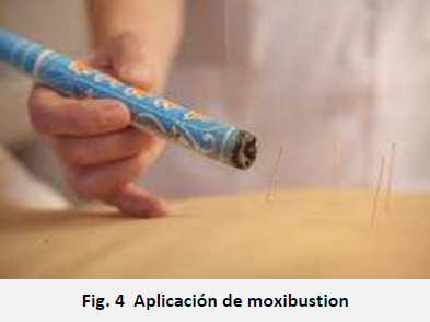 Moxibusti�n