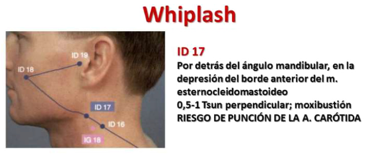 Traumatismo cervical con el punto
                              ID17