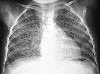 TB
                        lung with tubercles, X-ray photo