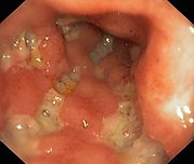 Morbus Crohn
                is an inflammation of intestine