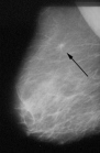 Breast cancer, X-ray
                            photo